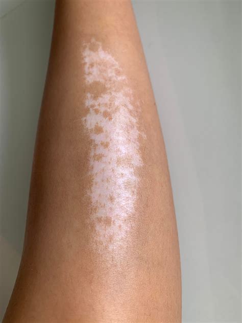 Welcome to rDermatologyQuestions Ask a dermatologist or medical professional on reddit. . Hypopigmentation scar reddit